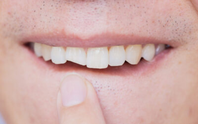 Ricostruzione denti rotti o scheggiati – Dentista Roma