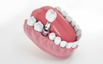 Implantologia Dentale e Terapie Indolori e di Rapida Guarigione