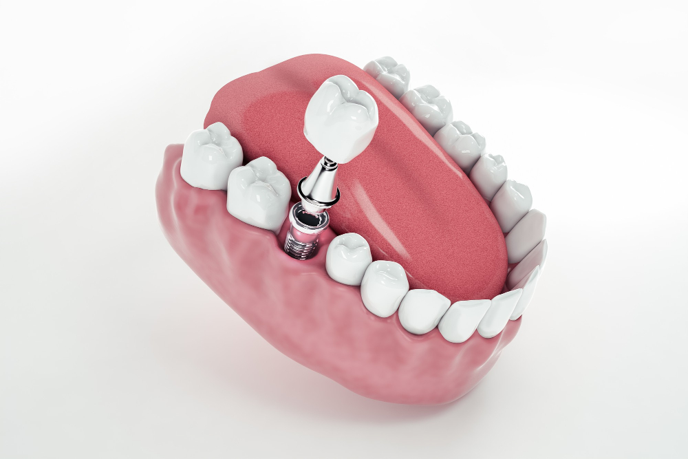 Implantologia Dentale e Terapie Indolori e di Rapida Guarigione