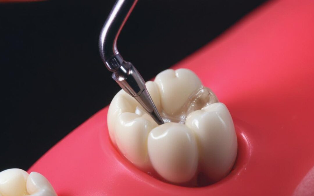 Estrazione del dente malato o cura e conservazione?